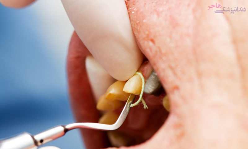 Gingival Retraction Cord